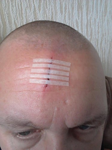 HypaCover Skin Closure Strips Large PK6 64mm x 76mm